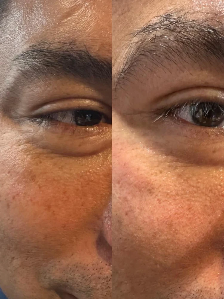 Fillerina — Antes y después patas de gallo