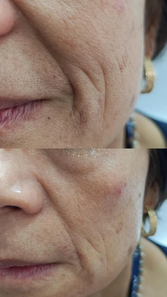 Fillerina — Antes y después surco nasogeniano
